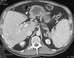 Cavernous Transformation of the Portal Vein - CTisus CT Scan