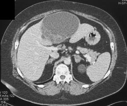 Biliary Cystadenocarcinoma - CTisus CT Scan