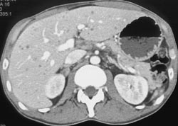 Candidiasis - CTisus CT Scan