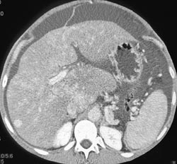 Regenerating Nodules With Cirrhosis - CTisus CT Scan