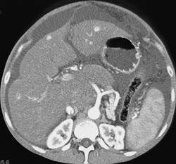 Regenerating Nodules - CTisus CT Scan