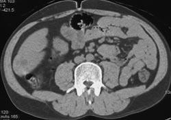 Hepatoma - CTisus CT Scan