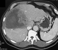 Hepatoma With Spontaneous Bleed - CTisus CT Scan