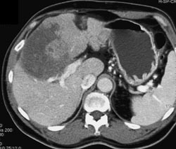 Hepatoma - CTisus CT Scan