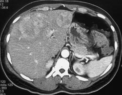 Carcinoid Tumor With Liver Metastases - CTisus CT Scan