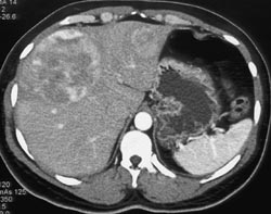 Metastatic Carcinoid Tumor - CTisus CT Scan