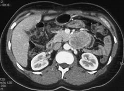 Carcinoid Tumor in Jejunum - CTisus CT Scan