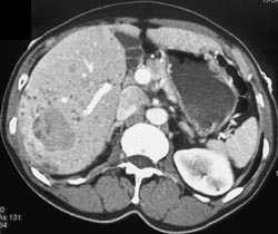 Multifocal Hepatocellular Carcinoma (HCC) - CTisus CT Scan