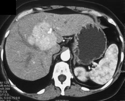 Focal Nodular Hyperplasia (FNH) - CTisus CT Scan