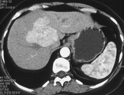 Focal Nodular Hyperplasia (FNH) Which Becomes Isodense - CTisus CT Scan