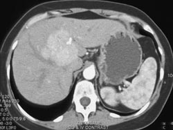 Focal Nodular Hyperplasia (FNH) - CTisus CT Scan