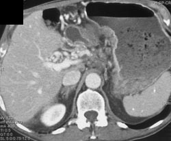 Cavernous Transformation of the Portal Vein - CTisus CT Scan