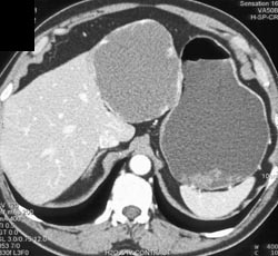 Hemangioma - CTisus CT Scan