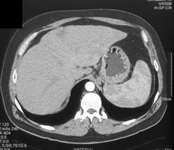 Hemangioma - CTisus CT Scan