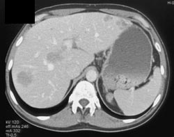 Carcinoid Metastases to the Liver - CTisus CT Scan