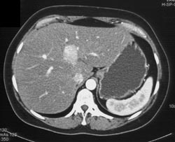 Focal Nodular Hyperplasia (FNH) - CTisus CT Scan