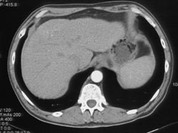 Hepatoma - CTisus CT Scan