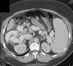 Cirrhosis With Varices - CTisus CT Scan