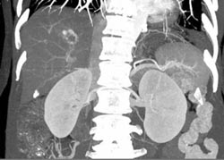 Hemangioma - CTisus CT Scan