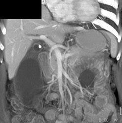 Mirizzis Syndrome - CTisus CT Scan