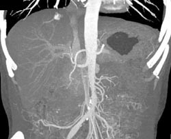 Hemangioma - CTisus CT Scan