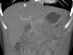 Hemangioma - CTisus CT Scan