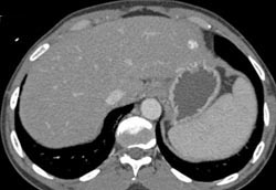 Hemangioma- 1 Cm - Left Lobe - CTisus CT Scan