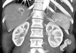 Hemangioma - CTisus CT Scan