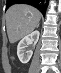 Hemangioma - CTisus CT Scan