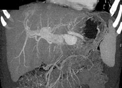 Hepatoma - CTisus CT Scan