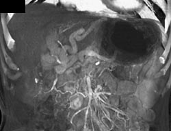 Cavernous Transformation of the Portal Vein (CTPV) - CTisus CT Scan