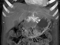 Hemangioma in Left Lobe - CTisus CT Scan