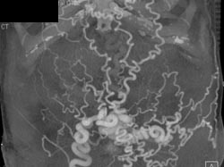 Varices in Cirrhosis - CTisus CT Scan