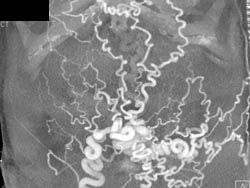 Abdominal Wall Collaterals in Portal Hypertension - CTisus CT Scan