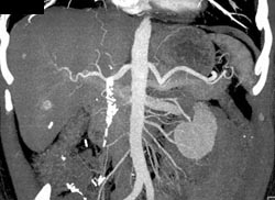 Hemangioma - CTisus CT Scan