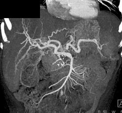 Cirrhosis - CTisus CT Scan