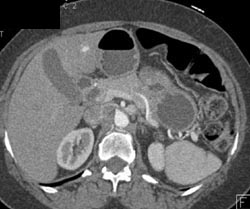 Hemangioma - CTisus CT Scan