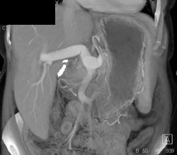 Portal Vein Patency - CTisus CT Scan