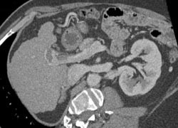 Clot in the Portal Vein - CTisus CT Scan