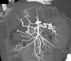 Hepatoma- See Upper Third of Ct - CTisus CT Scan