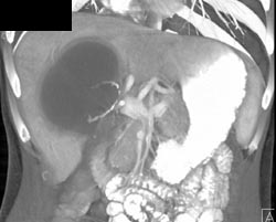 Infected Biloma - CTisus CT Scan