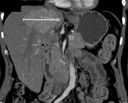 Focal Nodular Hyperplasia (FNH) - CTisus CT Scan