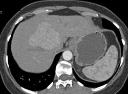 Focal Nodular Hyperplasia (FNH) - CTisus CT Scan