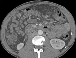 Clot Mesocaval Shunt - CTisus CT Scan