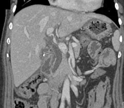 Dilated Common Bile Duct - CTisus CT Scan