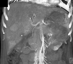 Cirrhosis - CTisus CT Scan