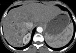 Cholangiocarcinoma - CTisus CT Scan