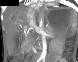 Cholangiocarcinoma - CTisus CT Scan