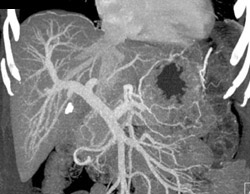 Portal Venous Anatomy - CTisus CT Scan