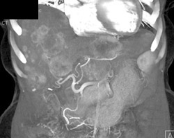 Metastatic Islet Cell Tumor - CTisus CT Scan